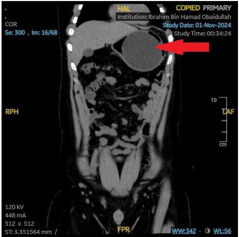 Acute Pancreatitis Following Intragastric Balloon Placement in a Young Adult: A Case Report and Literature Review