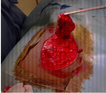 Surgical Treatment of Frontal Darier-Ferrand Dermatofibrosarcoma (DFS) About a Case
